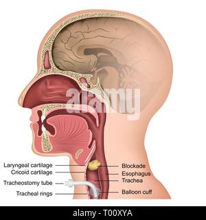 Tracheotomie medizinische Vector Illustration auf weißem Hintergrund Stock Vektor