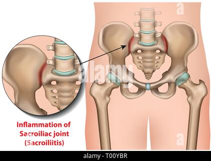 Iliosakralgelenk Entzündung 3 d medical Vektor-illustration sacroiliitis Stock Vektor