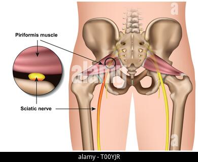 Piriformis-Syndrom 3 d medical Vector Illustration auf weißem Hintergrund Stock Vektor