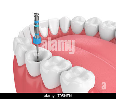 3D-Render von Zahn mit Endodontischen Datei im Kiefer auf weißen Hintergrund. Wurzelbehandlung Konzept. Stockfoto