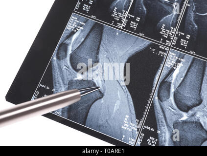 MRI - Schaden von Cross-förmigen Bändern Stockfoto