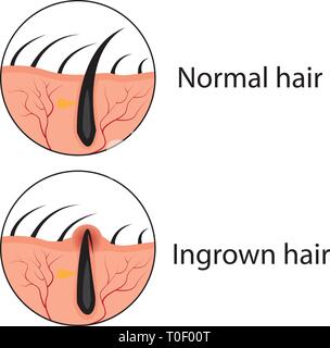 Normal und eingewachsene Haare Vector Illustration. Hautpflege Problem. Stock Vektor