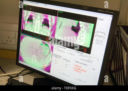Computer Bildschirm mit Scans in der Strahlentherapie eingesetzt werden. Stockfoto