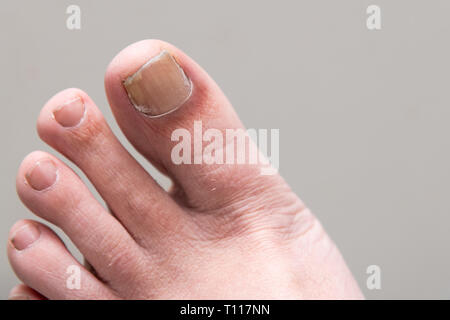 Männer Fuß onychomycosis mit Pilzen Nagelinfektion Stockfoto