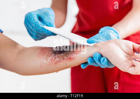 Schulung in Erster Hilfe. Brennen Sie Verletzungen. Erste Hilfe Kurs. Stockfoto