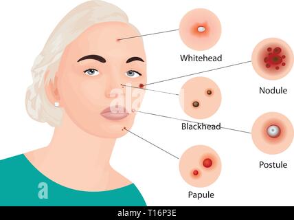 Akne Arten auf einer Fläche Vector Illustration. - Kosmetika Hautpflege, Haut Behandlung Stock Vektor