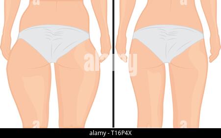 Fett und Slim's Mädchen zurück. Fat thig. Fettabsaugung. Vor und Nach. Frau Body Correction Vector Illustration Stock Vektor