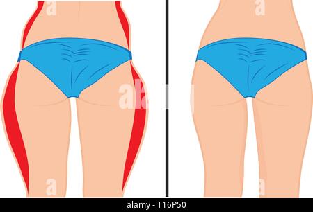 Fett und Slim's Mädchen zurück. Fat thig. Fettabsaugung. Vor und Nach. Frau Body Correction Vector Illustration Stock Vektor