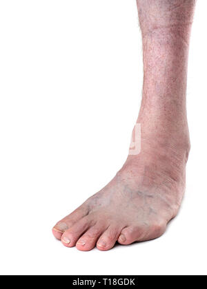 Erwachsene männliche mit Club foot aka talipes, trotz Kindheit eingreifen. Auf weiß. Stockfoto