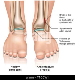 Sprunggelenk Fraktur medizinische Vector Illustration auf weißem Hintergrund Stock Vektor
