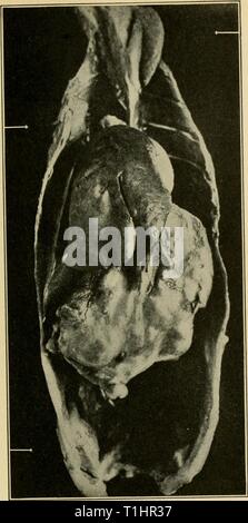 Krankheiten des Geflügels; ihre Ätiologie, Krankheiten von Geflügel; ihre Ätiologie, Diagnose, Behandlung und Prävention diseasesofpoultr 00 Erbse Jahr: 1915 Abb. 69. - Huhn tumor XVIII im Muskelmagen des ursprünglichen Geflügel. Drei Metastasen sind in der Skelettmuskulatur sichtbar und zwar im Nacken, der Andere in der Höhe der Brustwirbelsäule Wand über dem rechten Lappens der Leber und der Dritte auf die Innenfläche des Beckens. Alle sind durch Pfeile gekennzeichnet. (Nach Rous und Lange.) Stockfoto