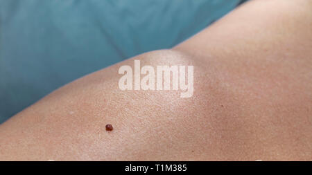 Nahaufnahme von einem braunen erhöht Haut Mole, die eine Ursache für das Melanom oder Hautkrebs. Stockfoto