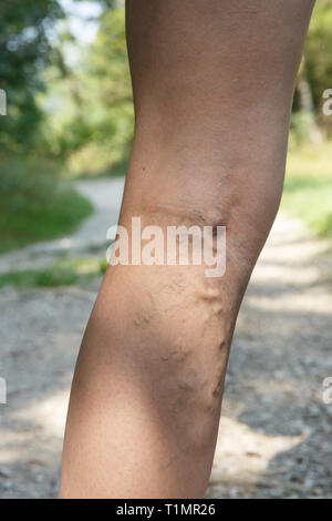 Frau mit schmerzhaften, geschwollene Krampfadern ruht auf einem Spaziergang durch die Natur. Varizen, Besenreiser Probleme und aktiven Lebensstil Prävention. Stockfoto