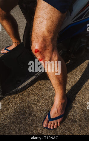 Ein Mann Bein mit einem frischen Quetschung durch einen Unfall mit einem Motorroller in Koh Tao, Thailand verursacht Stockfoto