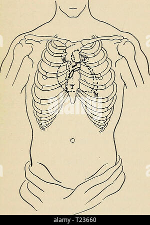 Archiv Bild ab Seite 202 von Richtungen, die für die Arbeit im Labor in Richtungen für die Arbeit im Labor in der Physiologie directionsforlab 1906 lomb Jahr: 1906 normale Sounds von ilKAKT. 179 EXPERIMENT XXXII. Die normalen Geräusche des Herzens. Die normale Herztöne können mit dem blossen Ohr hören, aber das Stethoskop wird häufig verwendet. Es besteht Abb. 37. Darstellung der Position des Herzens in cliest, Position der Ventile wie an der Wand der Brust projiziert, und die Teile der Brust, wo die Klänge des Herzens am besten zu hören sind. M. in der Position des Apex Beat und Sound von mitralklappe; T, Ton aus tricusp Stockfoto