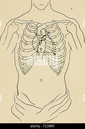 Archiv Bild ab Seite 252 von Richtungen, die für die Arbeit im Labor in Richtungen für die Arbeit im Labor in der Physiologie für die Verwendung von Medizinstudenten directionsforlab 00 lomb Jahr: 1914 NORMA!, SOUNDS OP HERZ. 223 EXPERIMENT XXXIX. Die normalen Geräusche des Herzens. Die normale Herztöne können mit dem blossen Ohr hören, aber das Stethoskop wird häufig verwendet. Es besteht es Abb. 42. Darstellung der Position der Herzen in der Brust, Position der Ventile wie an der Wand der Brust projiziert, und die Teile der Brust, wo die Klänge des Herzens am besten zu hören sind. M, Position der Apex Beat und Sound von mit Stockfoto