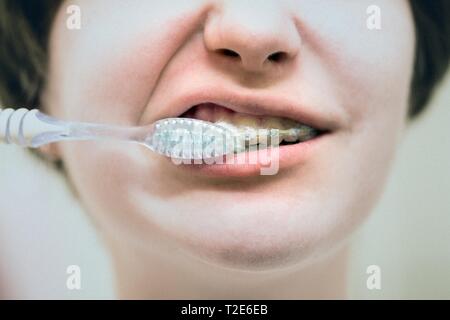 Mädchen mit zahnspangen Zähne putzen. close-up. Gesunde auch Zähne und Kieferorthopädie Stockfoto