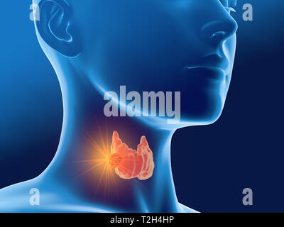 Medizinisch 3D-Abbildung mit Schilddrüsenkrebs einer Frau, medizinisch Abbildung auf blauem Hintergrund Stockfoto