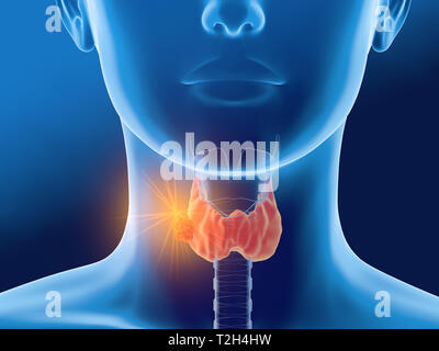 Medizinisch 3D-Abbildung mit Schilddrüsenkrebs einer Frau, medizinisch Abbildung auf blauem Hintergrund Stockfoto