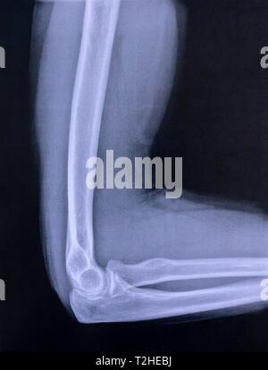 X-ray Image der Ellenbogen und Oberarm, Deutschland Stockfoto