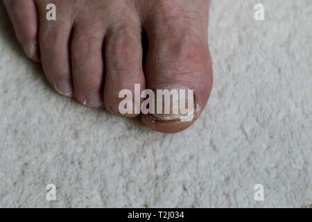 In der Nähe von alten Füße mit beschädigt und vernachlässigte Zehennägel. Pilz- und bakterielle Nageltrauma hautnah. Stockfoto