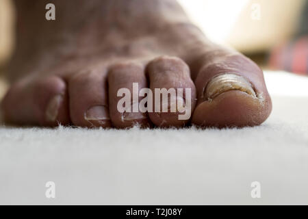 In der Nähe von Old Mans Füße. Beschädigte Zehennägel hautnah. Pilzinfektionen und abgeplatzte Zehennägel hautnah. Stockfoto
