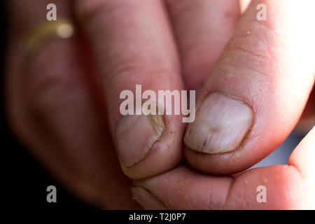 Fingernagel beschädigt in der Nähe der Old Mans Finger mit Nagelbett Verletzung. Nahaufnahme von der Nagelplatte Trauma. Stockfoto