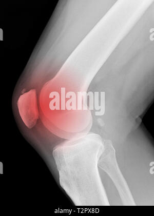 X-ray medizinische Bild-menschlichen Knie mit rotem Symbol der schmerzhaften Stelle Stockfoto