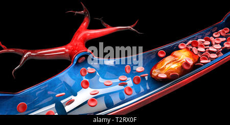 3 dIllustration der zerebralen Sklerose isolierten schwarzen Hintergrund. Stockfoto