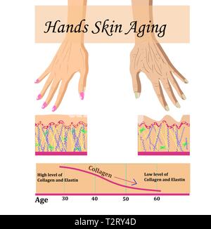 Hände Haut altern, infografik Vector Illustration mit einem Diagramm Stock Vektor