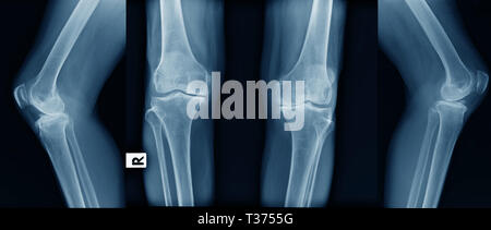 X-ray Image von OA Knie blau Ton Stockfoto