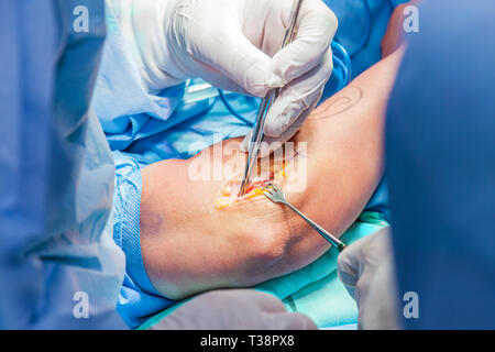 Gruppe der orthopädischen Chirurgen Chirurgie auf einen Patienten Arm Stockfoto