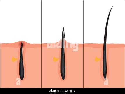Normal und eingewachsene Haare Vector Illustration. Hautpflege Problem. Stock Vektor