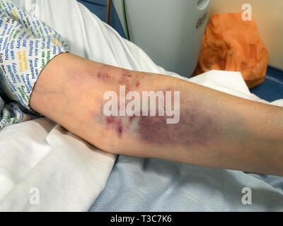 Eine Nahaufnahme der Arm der Frau schlecht aus mehreren Versuche an der Zeichnung Blut zerschlagen, der Rand der patientenkittel können gerade gesehen werden. Stockfoto