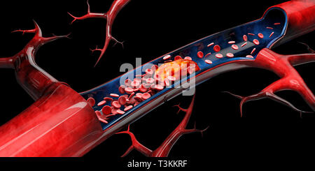 3 dIllustration der zerebralen Sklerose isolierten schwarzen Hintergrund. Stockfoto