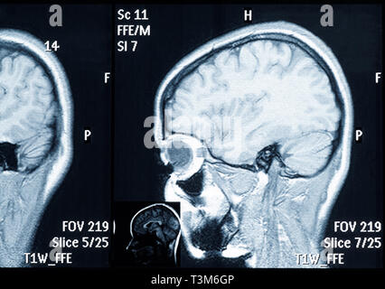 Echten MRT des Gehirns Folie einer jungen Frau. Patienten und der Klinik Namen entfernt Stockfoto