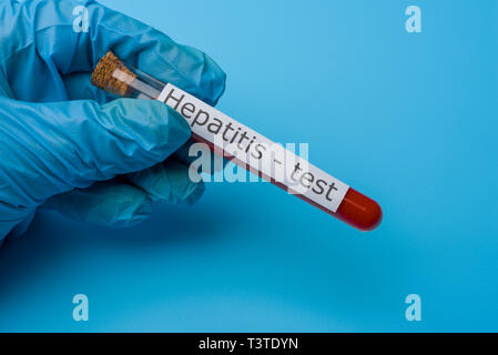 Hepatitis test, Blut im Reagenzglas. Das Konzept von Medizin und Analyse. Stockfoto