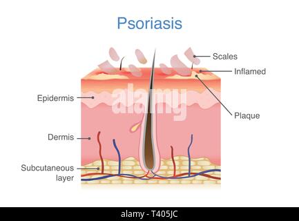 Die menschliche Haut Layer bei Plaque-psoriasis Anzeichen und Symptome erscheinen. Stock Vektor