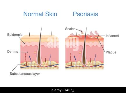 Normale Haut und Haut bei Plaque-psoriasis Anzeichen und Symptome erscheinen. Stock Vektor