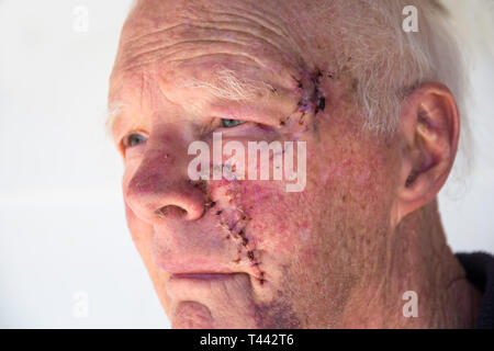 Ältere Europäische Männlich einen Tag nach der Operation Hautkrebse auf Wange und Tempel zu entfernen. Stockfoto