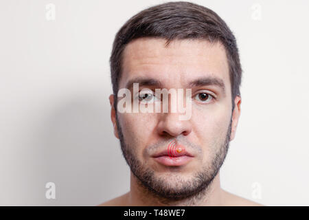 Herpes auf den Lippen des jungen Mannes. Schmerzen, nflammation der Lippe. Schöne Lippen Herpes Virus infiziert. Stockfoto