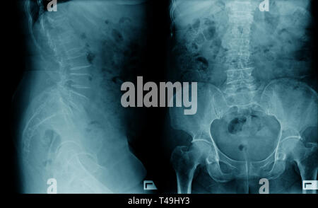 Lendenwirbelsäulenspondylose Röntgenbild AP UND SEITLICH anzeigen Stockfoto