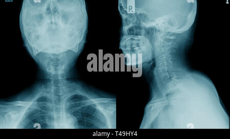 X-ray C-Wirbelsäule, bei zervikaler Spondylose x-ray Image Stockfoto