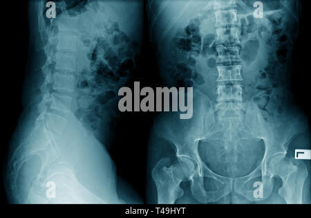 Lendenwirbelsäulenspondylose Röntgenbild AP UND SEITLICH anzeigen Stockfoto