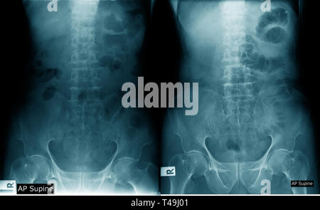 Lendenwirbelsäulenspondylose Röntgenbild AP UND SEITLICH anzeigen Stockfoto
