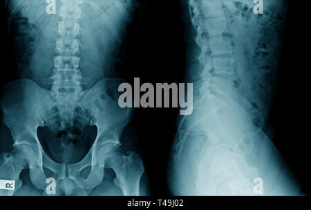 Lendenwirbelsäulenspondylose Röntgenbild AP UND SEITLICH anzeigen Stockfoto