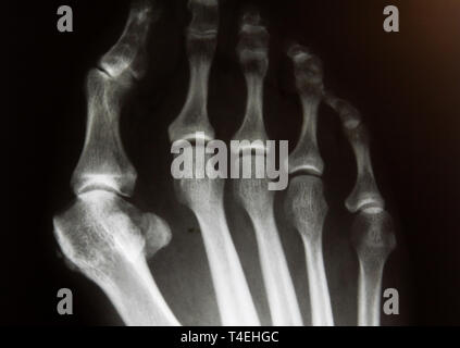 X-Ray Image der Vorfuß mit Hallux valgus Deformität Stockfoto