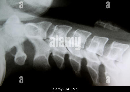 X-Ray Image der gesunden regelmäßigen Halswirbelsäule (negative Ergebnisse) Stockfoto