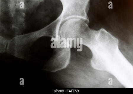 X-Ray Image der regelmäßigen Hüftgelenk Stockfoto