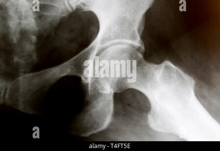 X-Ray Image der regelmäßigen Hüftgelenk Stockfoto